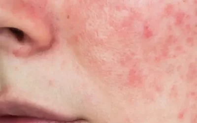Peeling químico: quién no debería hacerse uno