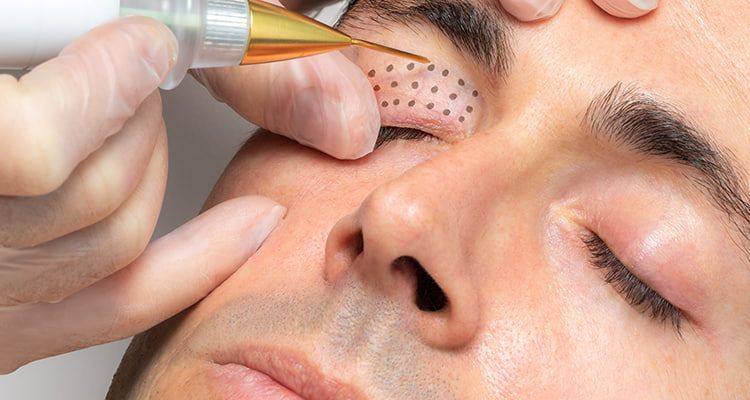 Arrugas faciales plasma pen