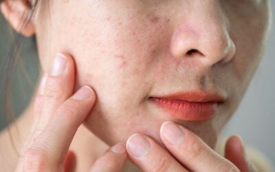 Rosácea: 5 consejos para combatirla de manera natural