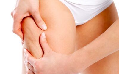 Grasa en las piernas: ¿por qué se acumula?