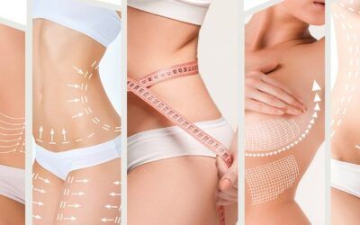 Flacidez Corporal: Descubre los Mejores Tratamientos para Reafirmar tu Piel y Mejorar tu Estética Corporal